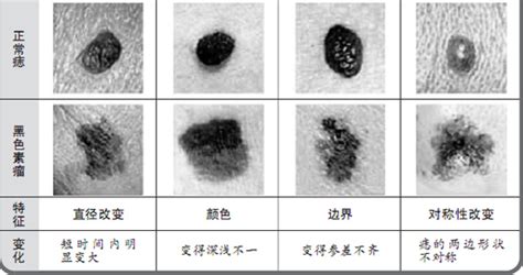 陰莖 黑痣